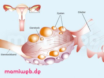 Polyzystisches Ovarialsyndrom