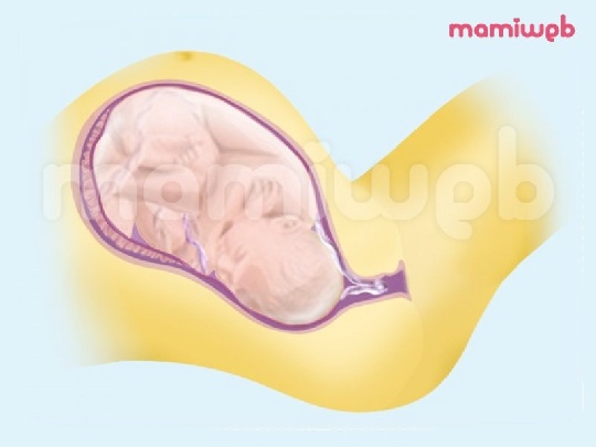 Wenn das Baby nicht atmen kann. nabelschnurvorfall