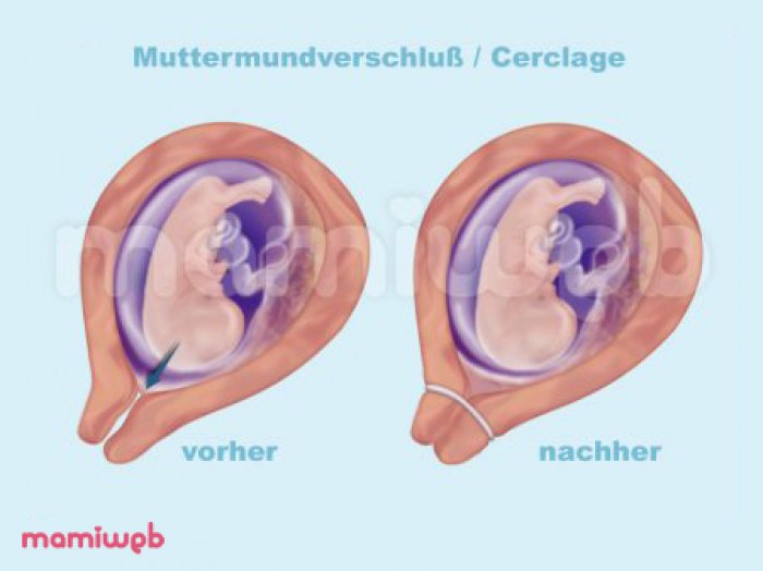 Muttermund 1 Cm Offen Druck Nach Unten www.mamiweb.de