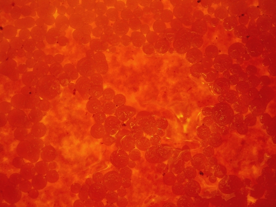 Endometriose endometriose