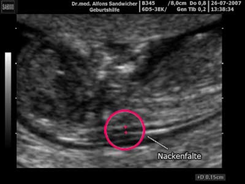 nackenfalte-auf-dem-ultraschallbild