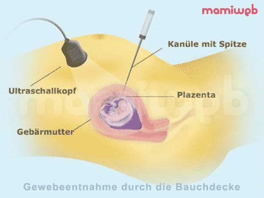 chorionzottenbiopsie-schwanger