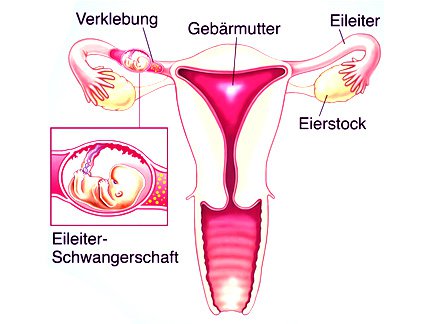 eileiterschwangerschaft