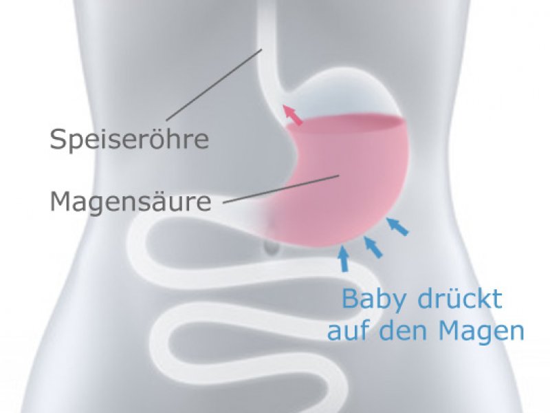 sodbrennen-schwangerschaft