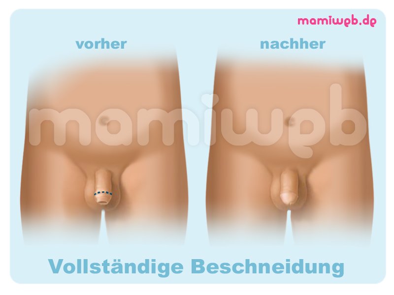 Erfahrungsbericht phimose beschneidung EURO CIRC