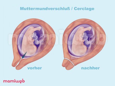 cerclage-eingriff