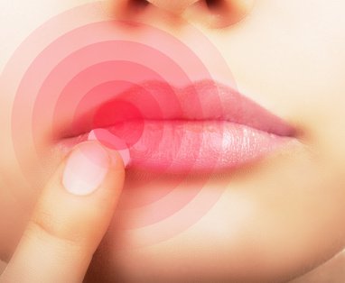 lippenherpes-in-der-schwangerschaft